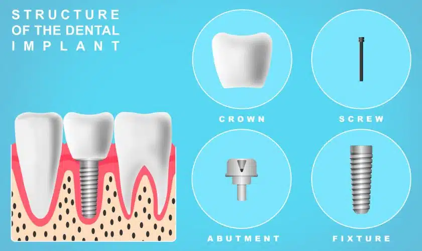 Dental Implants: Benefits, Procedure, and Aftercare