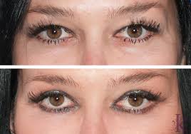 Upper and Lower Eyelid Surgery in New York City